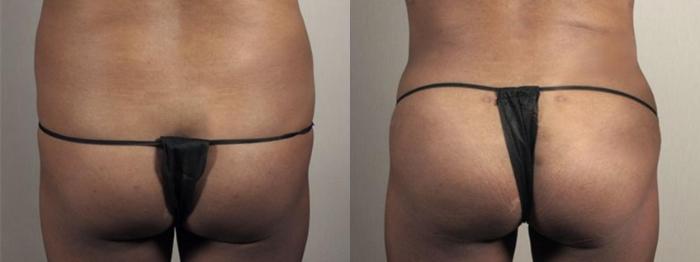 Brazilian Butt Lift Case 1340 Before & After Back | Paramus, New Jersey | Parker Center for Plastic Surgery