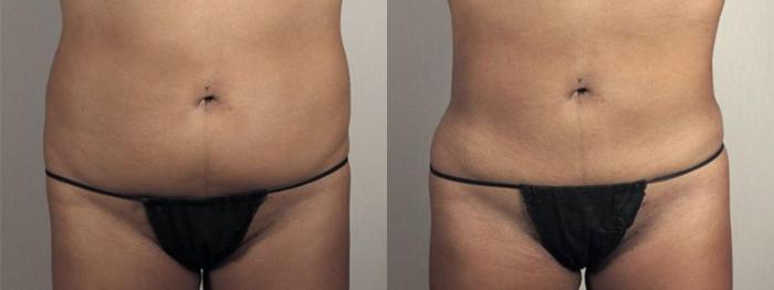 Brazilian Butt Lift Case 1340 Before & After Front | Paramus, New Jersey | Parker Center for Plastic Surgery