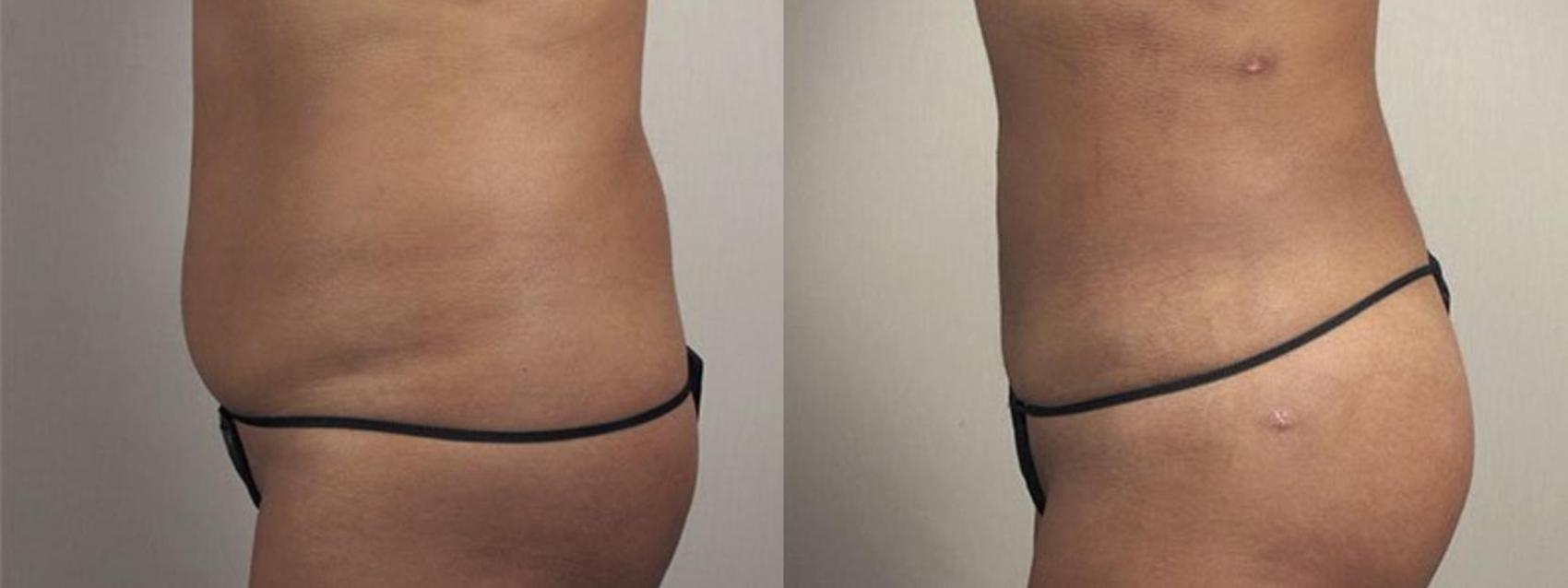 Brazilian Butt Lift Case 1340 Before & After Left Side | Paramus, New Jersey | Parker Center for Plastic Surgery