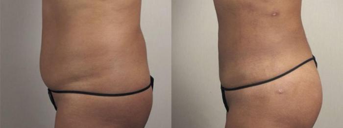 Brazilian Butt Lift Case 1340 Before & After Left Side | Paramus, New Jersey | Parker Center for Plastic Surgery