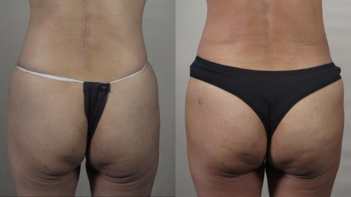 Brazilian Butt Lift Case 1497 Before & After Back | Paramus, New Jersey | Parker Center for Plastic Surgery
