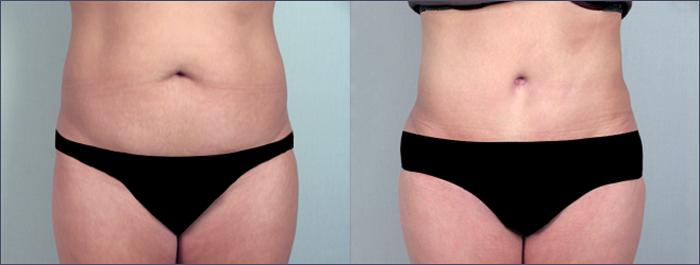 Brazilian Butt Lift Case 691 Before & After View #1 | Paramus, New Jersey | Parker Center for Plastic Surgery