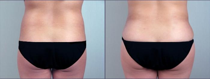 Brazilian Butt Lift Case 691 Before & After View #3 | Paramus, New Jersey | Parker Center for Plastic Surgery
