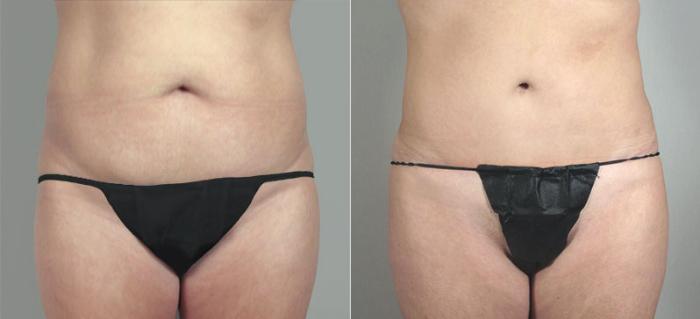 Brazilian Butt Lift Case 717 Before & After View #1 | Paramus, New Jersey | Parker Center for Plastic Surgery
