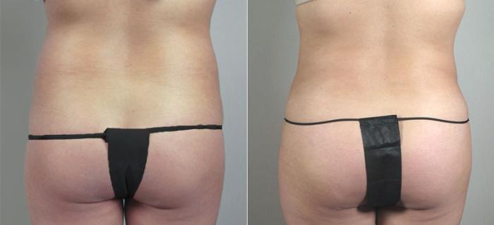 Brazilian Butt Lift Case 717 Before & After View #3 | Paramus, New Jersey | Parker Center for Plastic Surgery