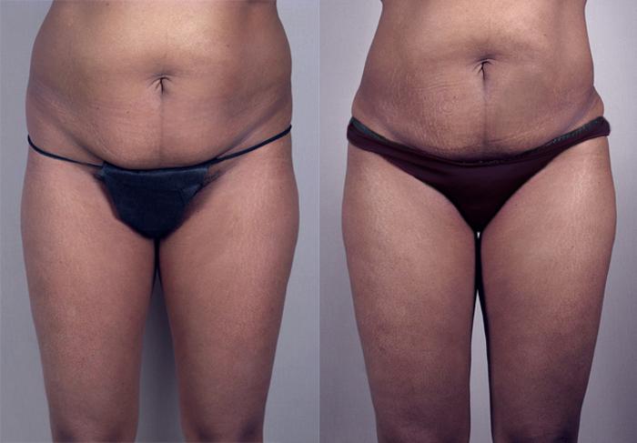 Brazilian Butt Lift Case 775 Before & After View #1 | Paramus, New Jersey | Parker Center for Plastic Surgery