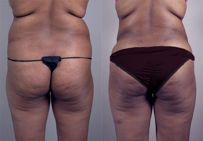 Brazilian Butt Lift Case 775 Before & After View #3 | Paramus, New Jersey | Parker Center for Plastic Surgery