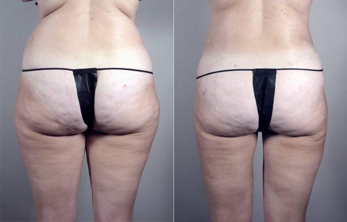Brazilian Butt Lift Case 791 Before & After View #1 | Paramus, New Jersey | Parker Center for Plastic Surgery
