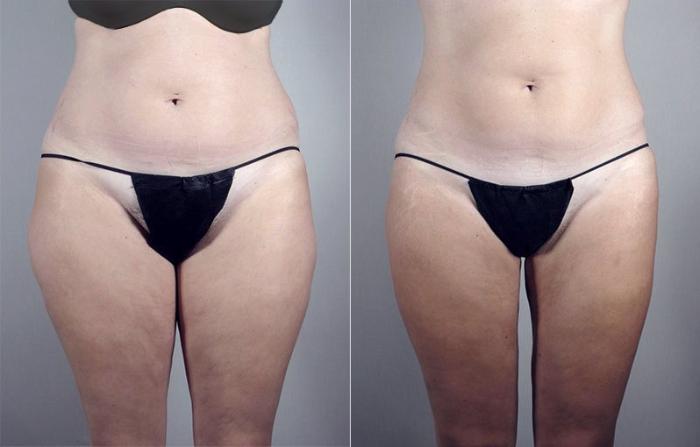 Brazilian Butt Lift Case 791 Before & After View #3 | Paramus, New Jersey | Parker Center for Plastic Surgery