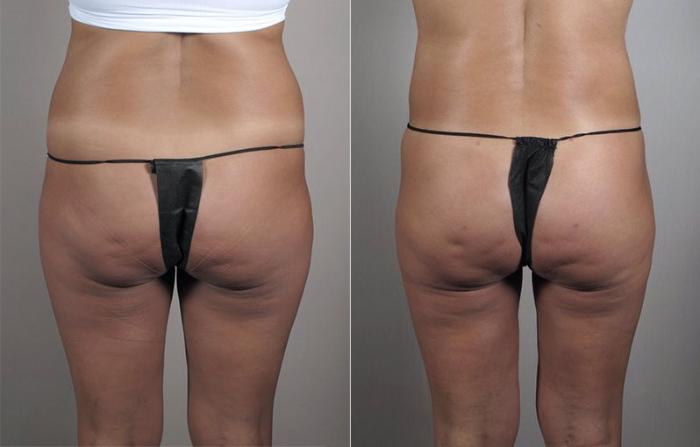 Brazilian Butt Lift Case 799 Before & After View #1 | Paramus, New Jersey | Parker Center for Plastic Surgery