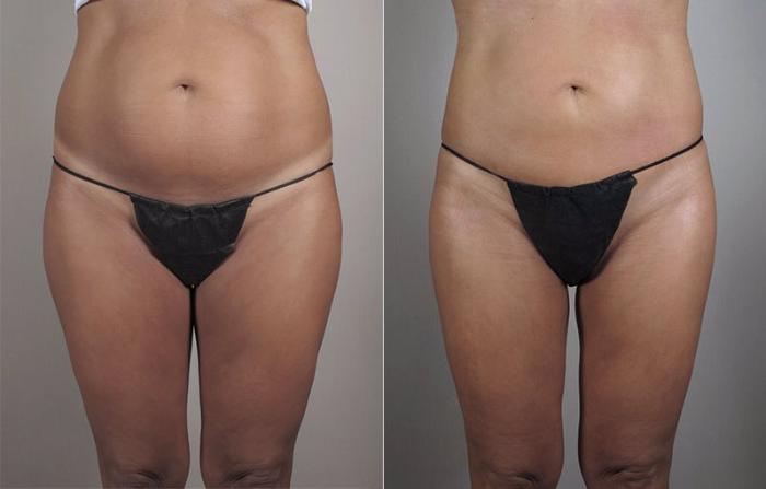 Brazilian Butt Lift Case 799 Before & After View #3 | Paramus, New Jersey | Parker Center for Plastic Surgery