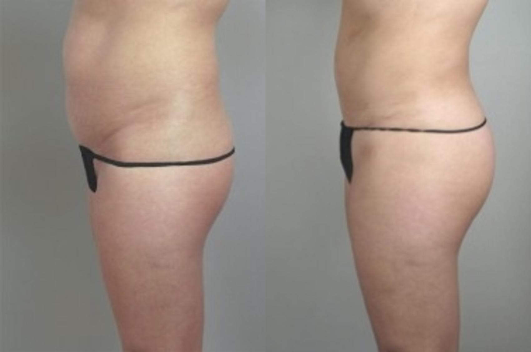 Brazilian Butt Lift Case 937 Before & After View #1 | Paramus, New Jersey | Parker Center for Plastic Surgery