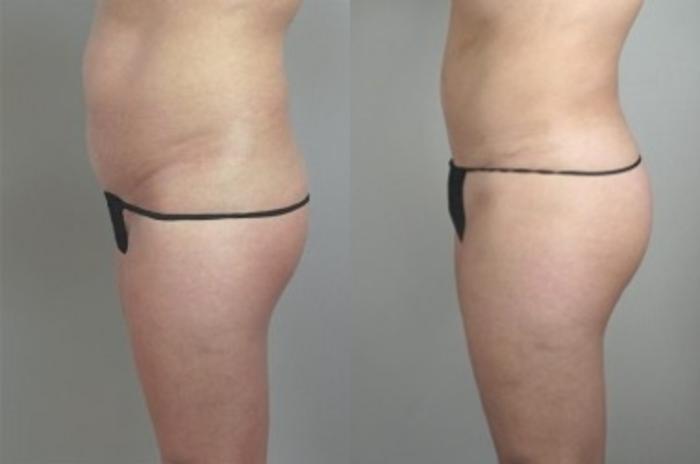 Brazilian Butt Lift Case 937 Before & After View #1 | Paramus, New Jersey | Parker Center for Plastic Surgery