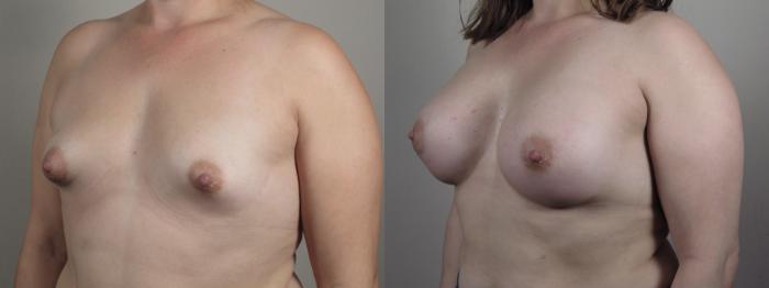 Breast Augmentation Case 1008 Before & After Right Oblique | Paramus, New Jersey | Parker Center for Plastic Surgery
