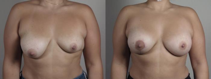 Breast Asymmetry Case 1012 Before & After Front | Paramus, New Jersey | Parker Center for Plastic Surgery