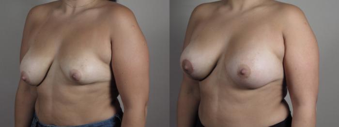 Breast Asymmetry Case 1012 Before & After Right Oblique | Paramus, New Jersey | Parker Center for Plastic Surgery
