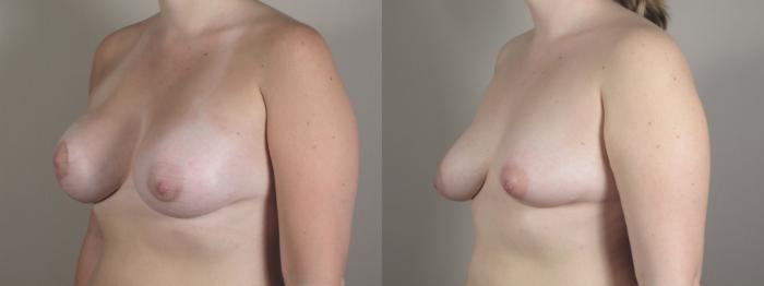 Breast Asymmetry Case 1021 Before & After Right Oblique | Paramus, New Jersey | Parker Center for Plastic Surgery