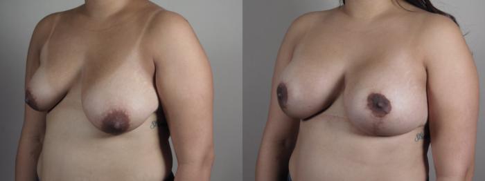 Breast Asymmetry Case 1023 Before & After Right Oblique | Paramus, New Jersey | Parker Center for Plastic Surgery