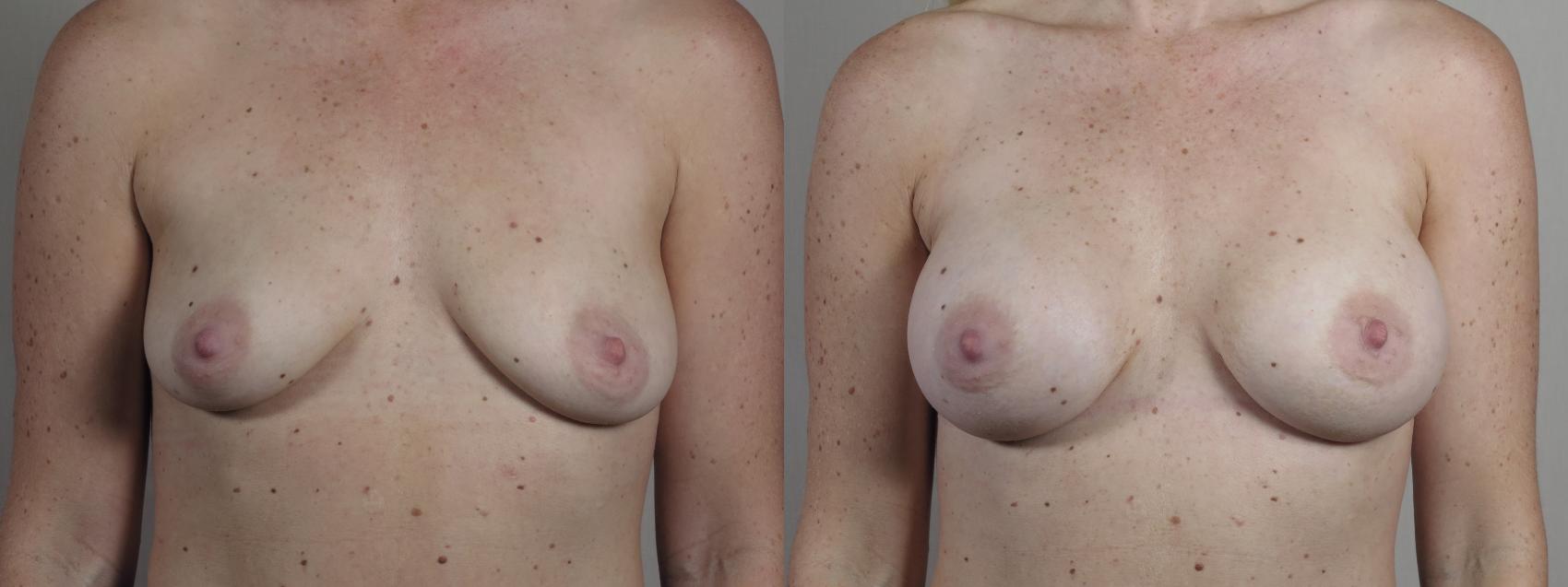 Breast Asymmetry Case 1332 Before & After Front | Paramus, New Jersey | Parker Center for Plastic Surgery