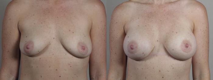 Breast Asymmetry Case 1332 Before & After Front | Paramus, New Jersey | Parker Center for Plastic Surgery