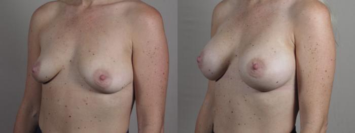 Breast Asymmetry Case 1332 Before & After Left Oblique | Paramus, New Jersey | Parker Center for Plastic Surgery
