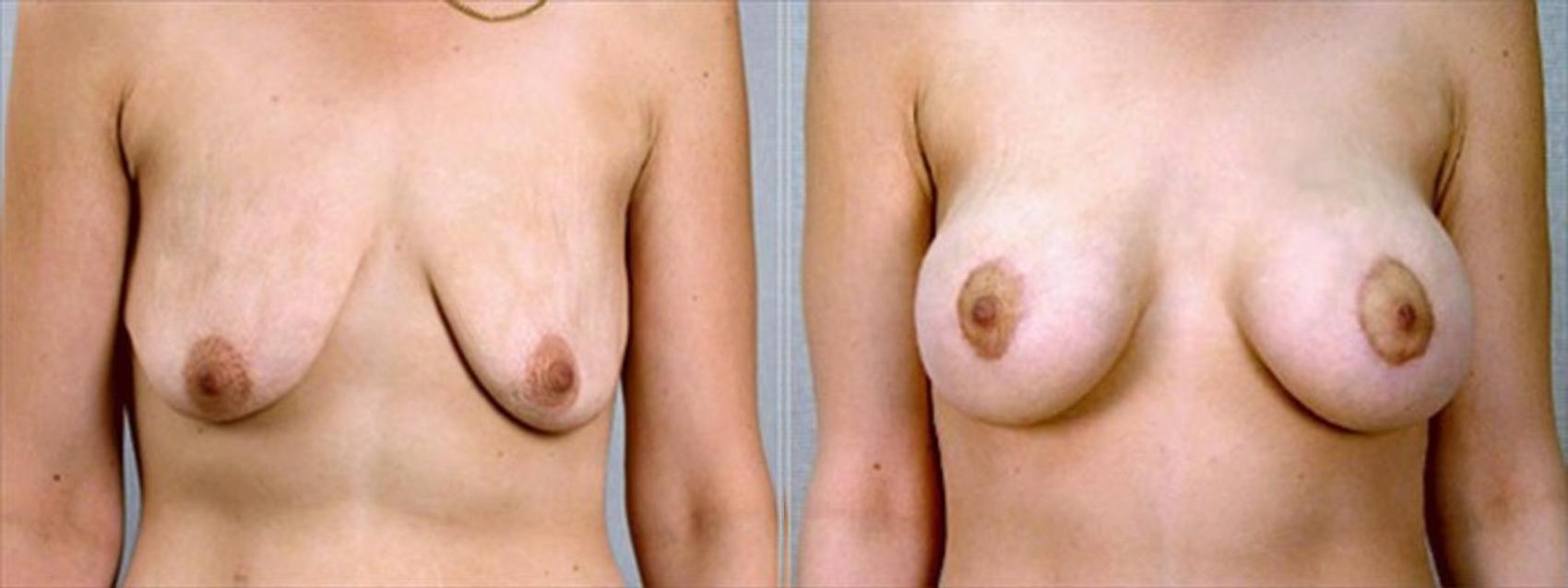 Breast Asymmetry Case 1346 Before & After Front | Paramus, New Jersey | Parker Center for Plastic Surgery