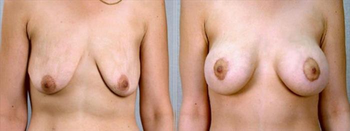 Breast Asymmetry Case 1346 Before & After Front | Paramus, New Jersey | Parker Center for Plastic Surgery