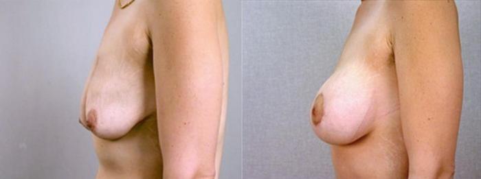 Breast Asymmetry Case 1346 Before & After Left Side | Paramus, New Jersey | Parker Center for Plastic Surgery