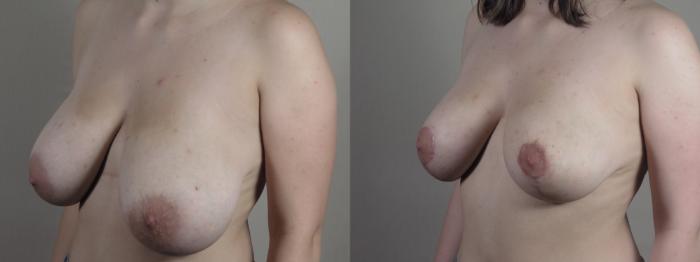 Breast Asymmetry Case 1369 Before & After Left Oblique | Paramus, New Jersey | Parker Center for Plastic Surgery
