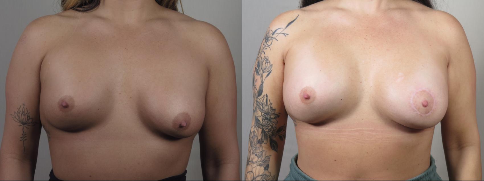 Breast Asymmetry Case 1536 Before & After Front | Paramus, New Jersey | Parker Center for Plastic Surgery