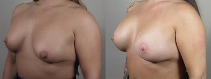 Breast Asymmetry Case 1536 Before & After Left Oblique | Paramus, New Jersey | Parker Center for Plastic Surgery