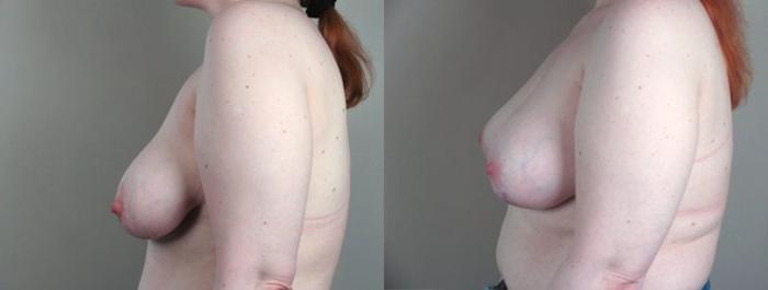 Breast Asymmetry Case 447 Before & After View #2 | Paramus, New Jersey | Parker Center for Plastic Surgery