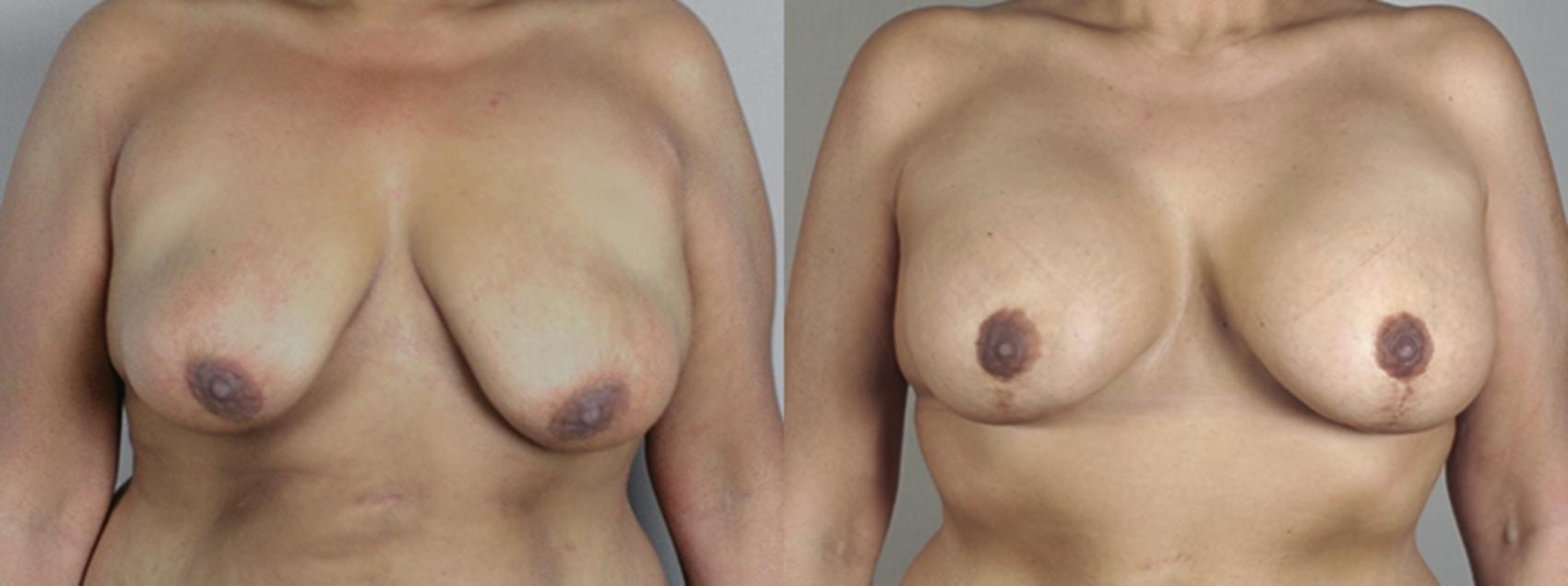Breast Asymmetry Case 468 Before & After View #1 | Paramus, New Jersey | Parker Center for Plastic Surgery