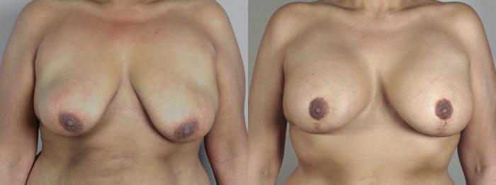 Breast Asymmetry Case 468 Before & After View #1 | Paramus, New Jersey | Parker Center for Plastic Surgery