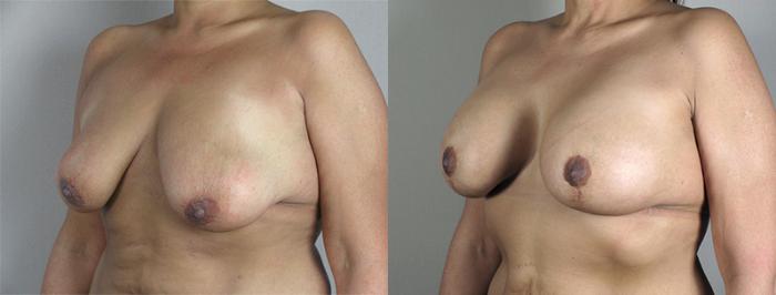 Breast Asymmetry Case 468 Before & After View #2 | Paramus, New Jersey | Parker Center for Plastic Surgery