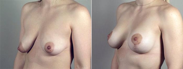 Breast Asymmetry Case 490 Before & After View #2 | Paramus, New Jersey | Parker Center for Plastic Surgery