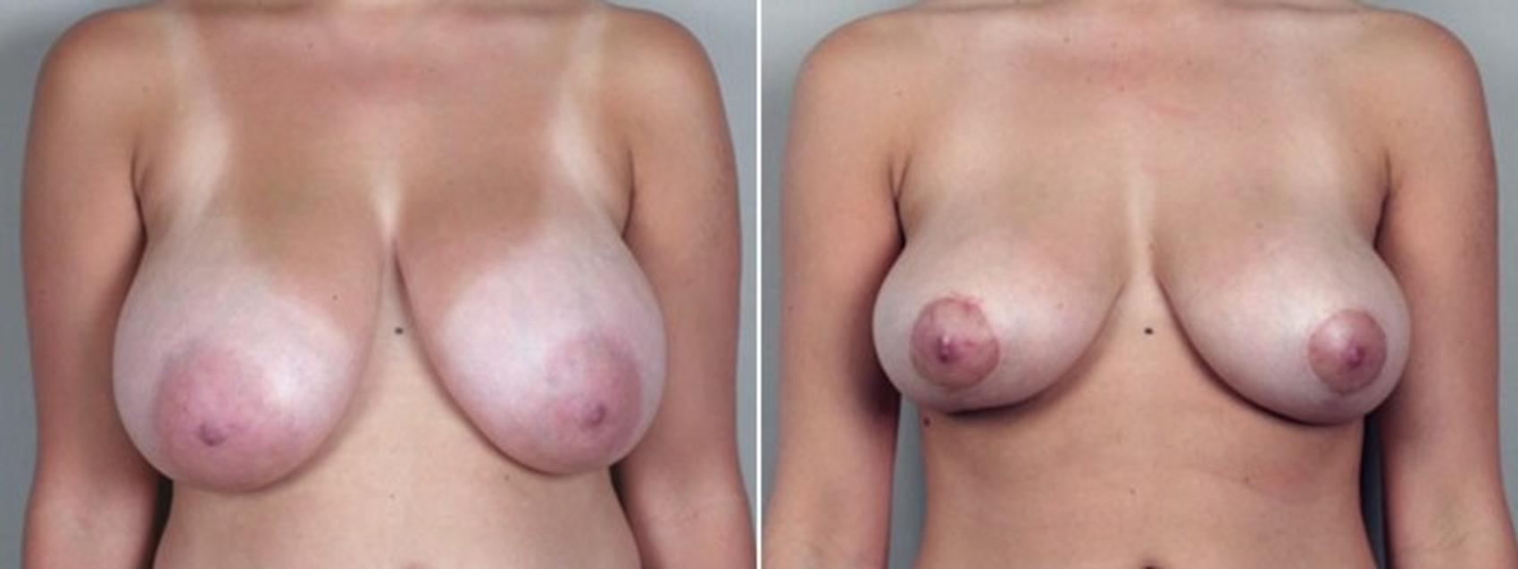 Breast Asymmetry Case 500 Before & After View #1 | Paramus, New Jersey | Parker Center for Plastic Surgery
