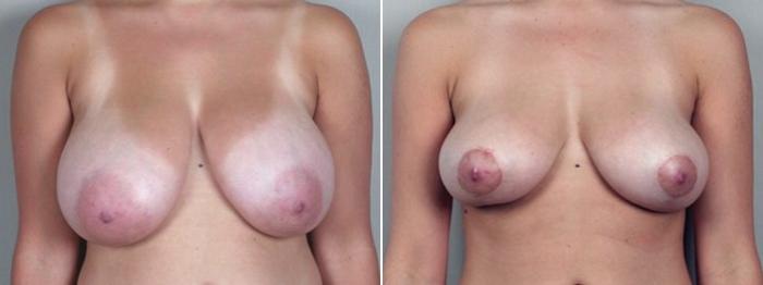 Breast Asymmetry Case 500 Before & After View #1 | Paramus, New Jersey | Parker Center for Plastic Surgery