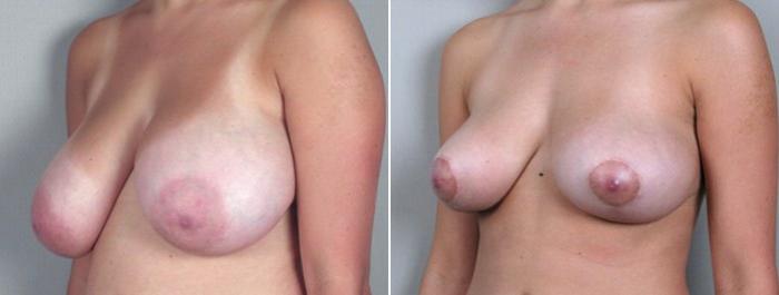 Breast Asymmetry Case 500 Before & After View #2 | Paramus, New Jersey | Parker Center for Plastic Surgery