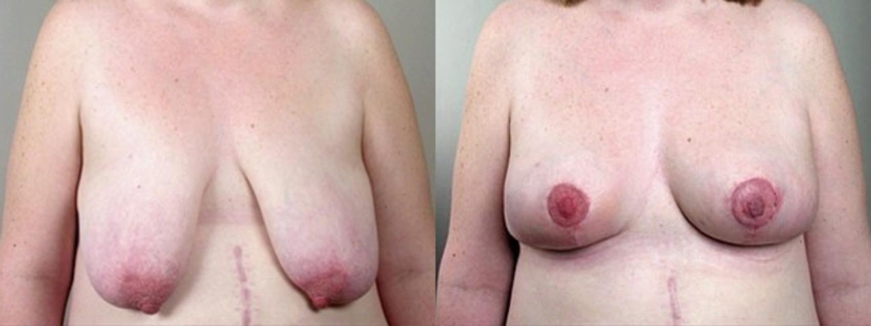 Breast Asymmetry Case 502 Before & After View #1 | Paramus, New Jersey | Parker Center for Plastic Surgery