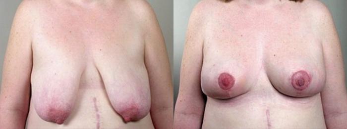Breast Asymmetry Case 502 Before & After View #1 | Paramus, New Jersey | Parker Center for Plastic Surgery