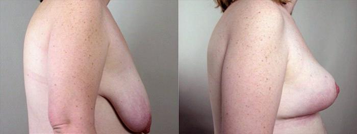 Breast Asymmetry Case 502 Before & After View #2 | Paramus, New Jersey | Parker Center for Plastic Surgery