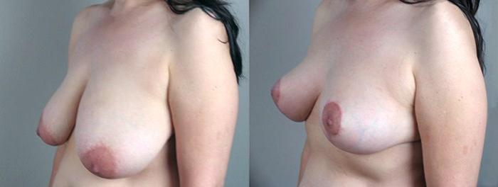 Breast Asymmetry Case 503 Before & After View #2 | Paramus, New Jersey | Parker Center for Plastic Surgery
