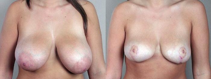 Breast Asymmetry Case 505 Before & After View #1 | Paramus, New Jersey | Parker Center for Plastic Surgery