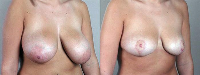 Breast Asymmetry Case 505 Before & After View #2 | Paramus, New Jersey | Parker Center for Plastic Surgery