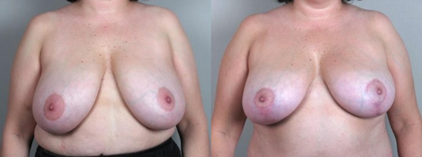 Breast Asymmetry Case 506 Before & After View #1 | Paramus, New Jersey | Parker Center for Plastic Surgery