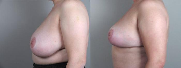 Breast Asymmetry Case 506 Before & After View #2 | Paramus, New Jersey | Parker Center for Plastic Surgery