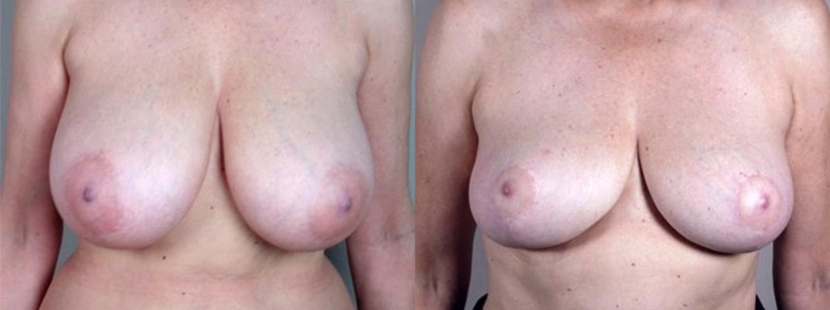 Breast Asymmetry Case 507 Before & After View #1 | Paramus, New Jersey | Parker Center for Plastic Surgery