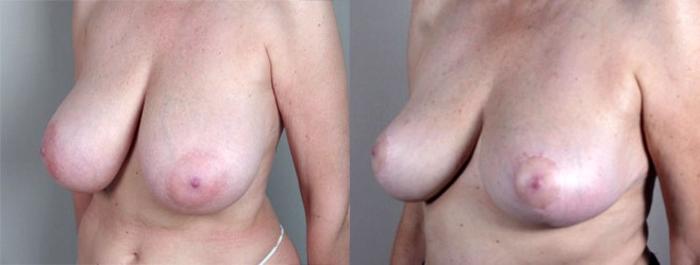 Breast Asymmetry Case 507 Before & After View #2 | Paramus, New Jersey | Parker Center for Plastic Surgery