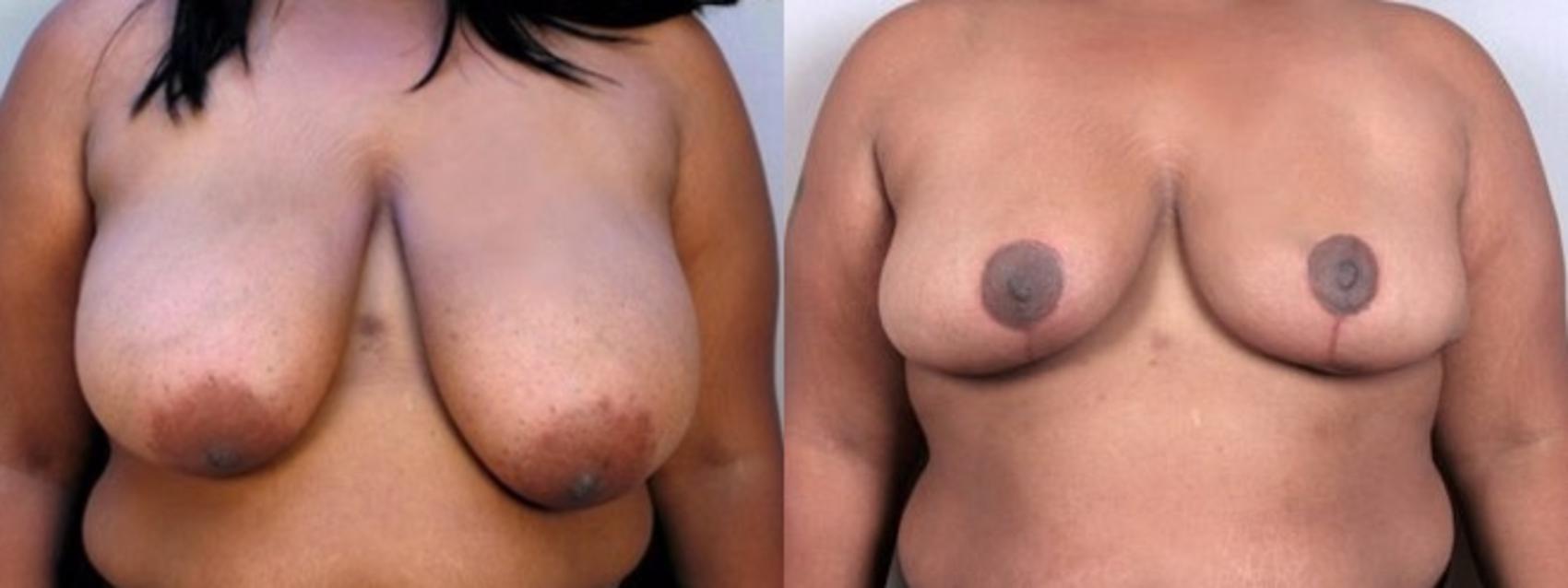 Breast Reduction Case 508 Before & After View #1 | Paramus, New Jersey | Parker Center for Plastic Surgery